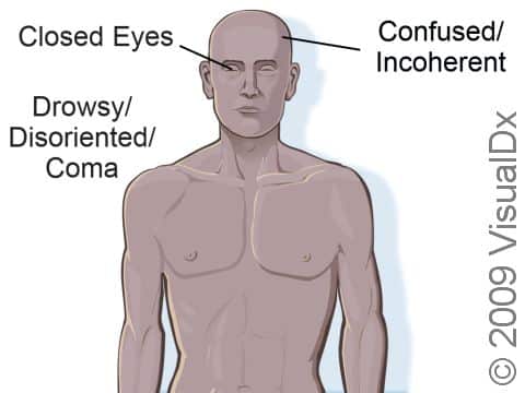 Unconsciousness signs and symptoms can include closed eyes, confusion, and drowsiness or unresponsiveness.