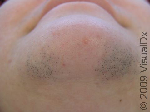 BEFORE: A chin prior to laser hair removal treatments.