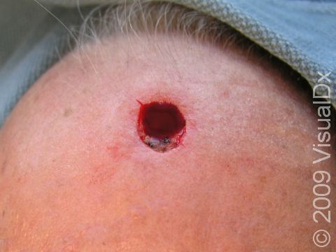 AFTER: Skin cancer has been removed from the forehead. This image was taken immediately after Mohs micrographic surgery.