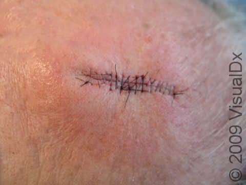 AFTER: After Mohs micrographic surgery, the skin is often repaired with sutures, as seen here.