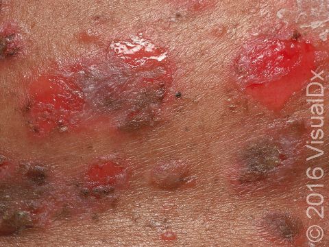 Close-up of the skin blisters and skin erosions of pemphigus vulgaris.