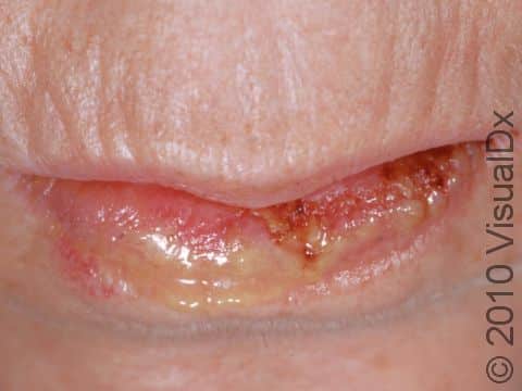 Crusting and loss of the skin of the lip frequently occurs with pemphigus vulgaris.