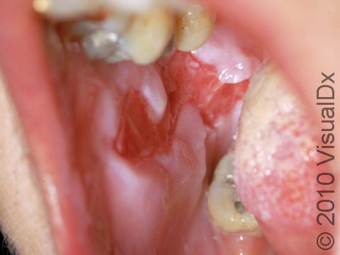 Close-up of oral ulcers from pemphigus vulgaris.