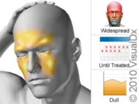 Sinus Headache