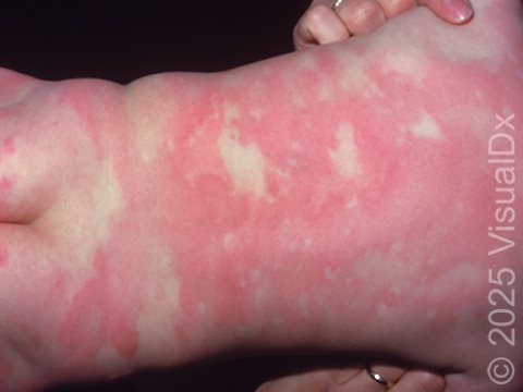 Urticaria (hives) can be extensive, forming large areas of redness.