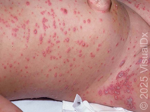 This image displays widespread blisters on an infant with varicella.