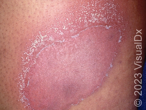 Red, scaly patches of skin with tiny pustules located along the edge of the redness in a patient with GPP.