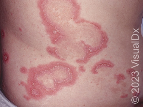 A common presentation of GPP on the trunk, where lesions have a curved or circular pattern with pustules at the edges.