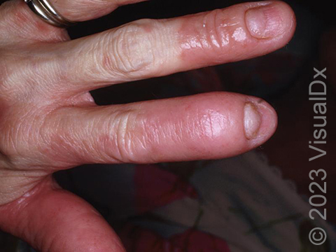 The swelling of one or more digits (also known as dactylitis or a 