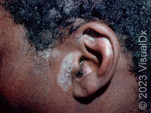 Subtle pink, scaly skin lesions of the ear and scalp of a patient with plaque psoriasis.