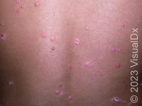 Guttate psoriasis results in the sudden development of small pink papules (elevated lesions) on the skin with overlying white scale.