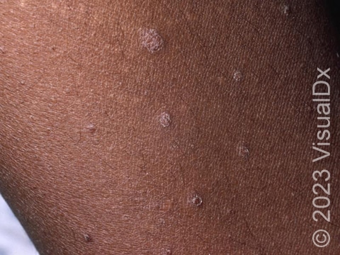 In skin of color, guttate psoriasis may appear as skin-colored lesions with fine white scale.