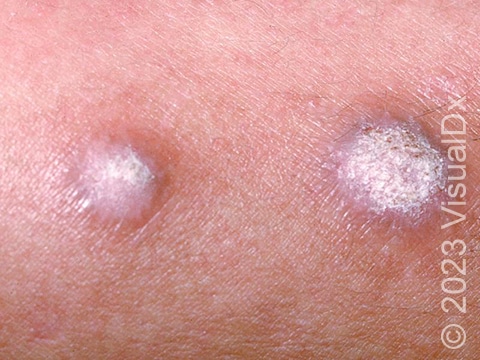 Thickened, scaly, pink nodules (raised bumps) in a patient with prurigo nodularis.